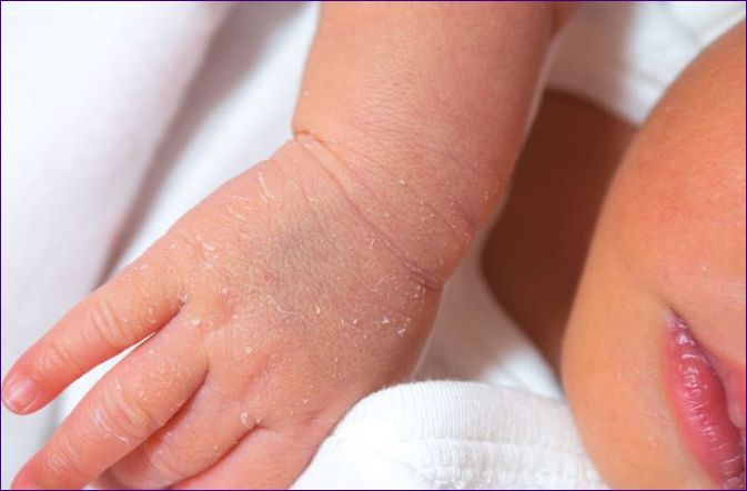 Sucha skóra u dziecka: 20 przyczyn i 10 środków zaradczych